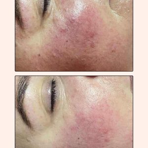 Facial of Vagheggi 75:25 facial of Vagheggi 75:25