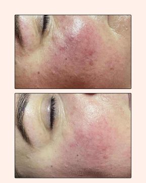 Facial of Vagheggi 75:25 facial of Vagheggi 75:25