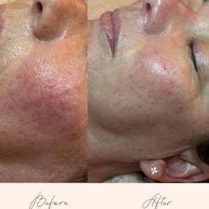 Before and after facial of Vagheggi 75:25 facial of Vagheggi 75:25