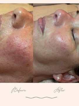 Before and after facial of Vagheggi 75:25 facial of Vagheggi 75:25