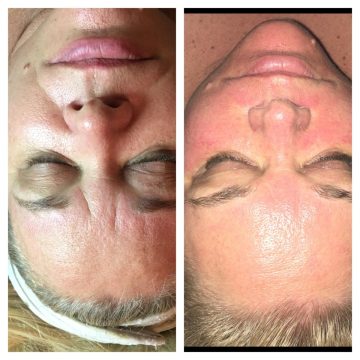 Aging Peel Aging Peel Facial